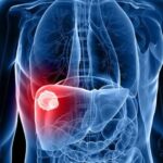 Liver Cancer