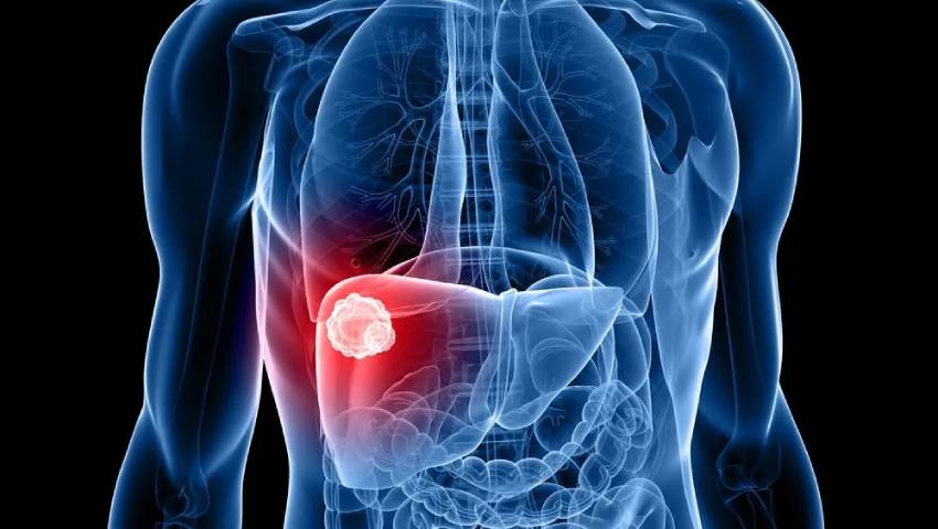 Major Risk Factors of Liver Cancer